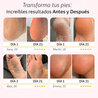 DermiSoft Quita Callos